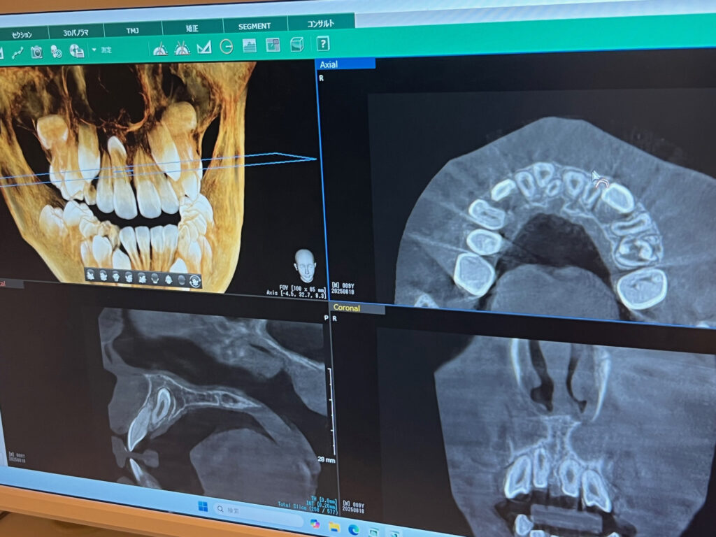 西新宿の新宿フロントタワー歯科では、上顎埋伏過剰歯の早期発見と小児矯正に取り組み、抜歯後にはコラーゲンスポンジを用いて治癒をサポートしています。