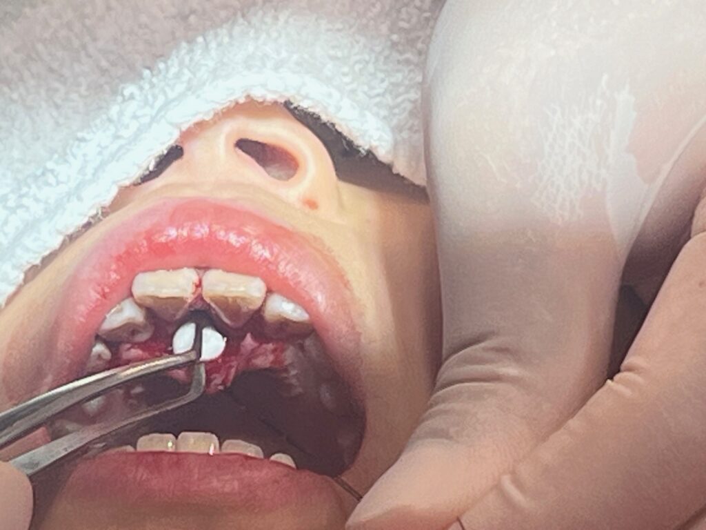 西新宿の新宿フロントタワー歯科では、上顎埋伏過剰歯の早期発見と小児矯正に取り組み、抜歯後にはコラーゲンスポンジを用いて治癒をサポートしています。