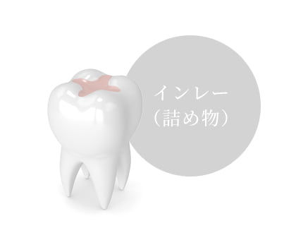 むし歯が小さい場合