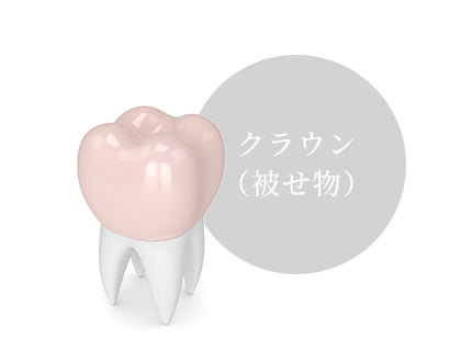 むし歯が大きい場合