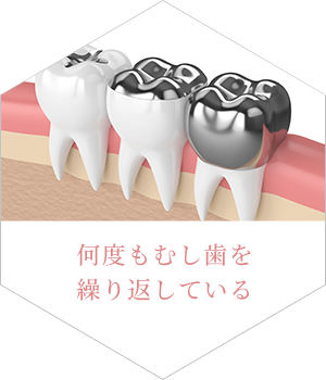 何度もむし歯を繰り返している