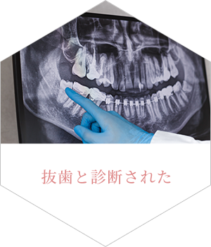 抜歯と診断された