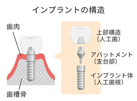 インプラントの構造