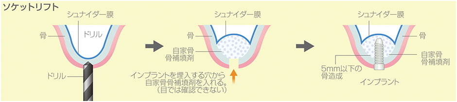 ソケットリフト