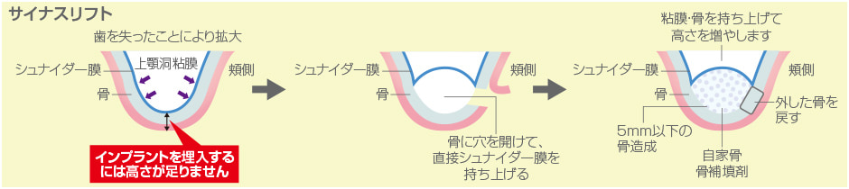 サイナスリフト