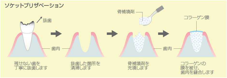 ソケットプリザベーション