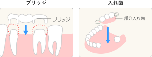 ブリッジと入れ歯の構造