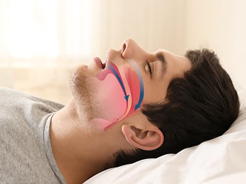 睡眠時無呼吸症候群
