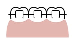 矯正後の後戻りが気になる