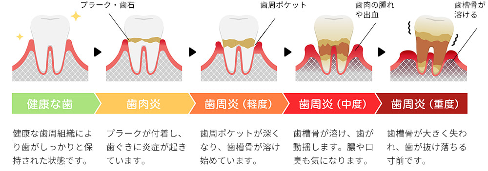 歯周病の進行
