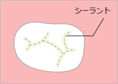 奥歯のむし歯を予防するシーラント