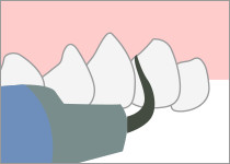 ①歯石の除去